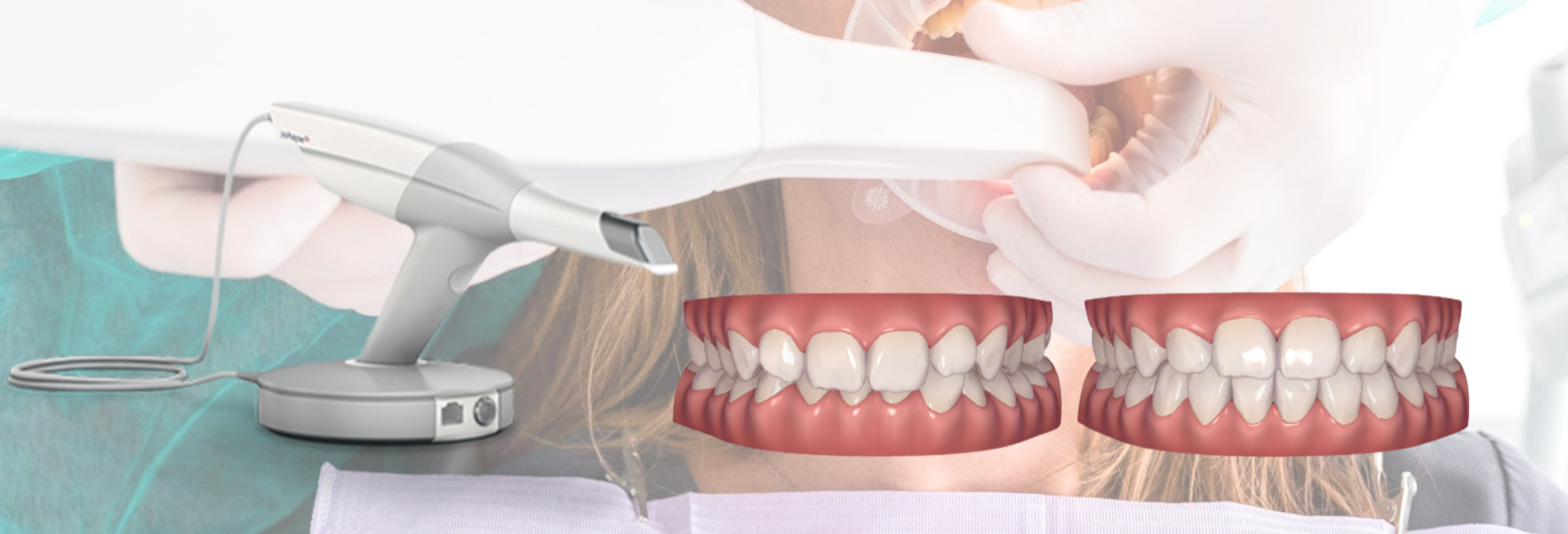 escaner intraoral